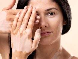 Indian diet plan for vitiligo