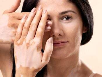 Indian diet plan for vitiligo