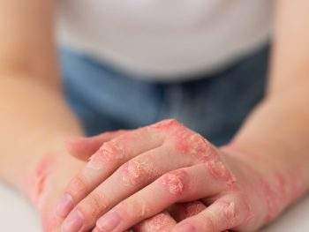 yoga for psoriasis