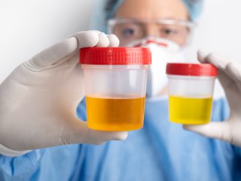 rbc and urine in pprotein