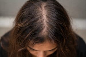biotin deficiency hair