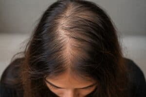 Nutritional Deficiencies and Hair Loss