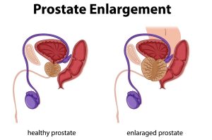 Enlarged Prostrate Diet Plan ( Foods to Eat and Avoid )